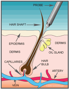 Electrolysis